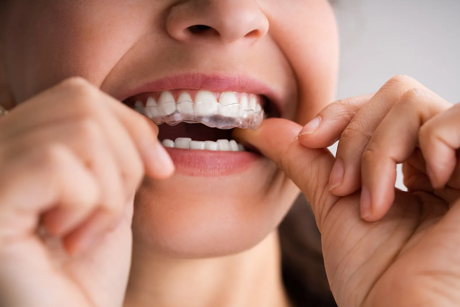 Common Dental Problems in Lehi UT, That Invisalign Can Fix